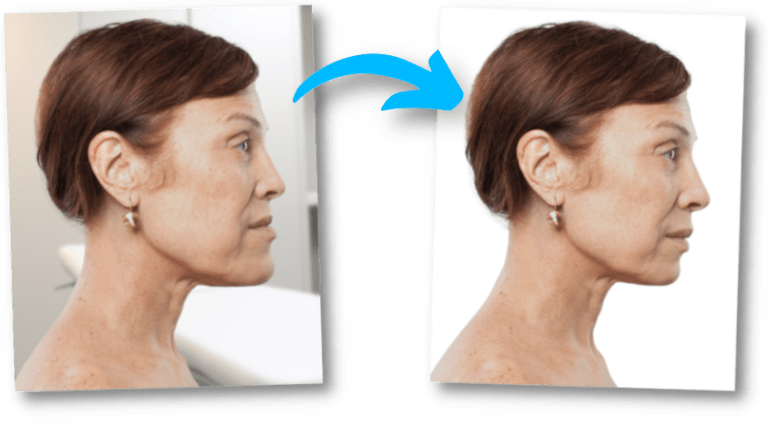 Classe III squelettique - Chirurgie des mâchoires