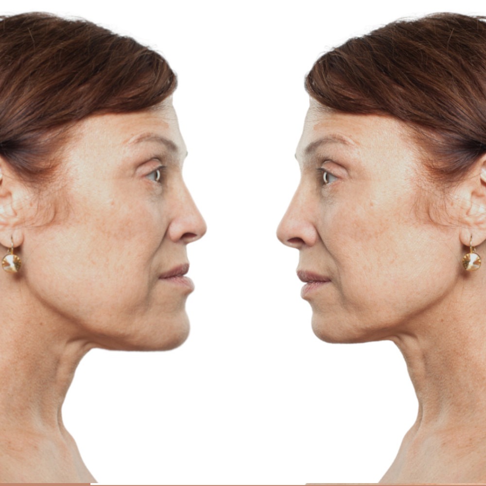 Simulation chirurgie esthétique Avant / Après Chirurgie Avant Après