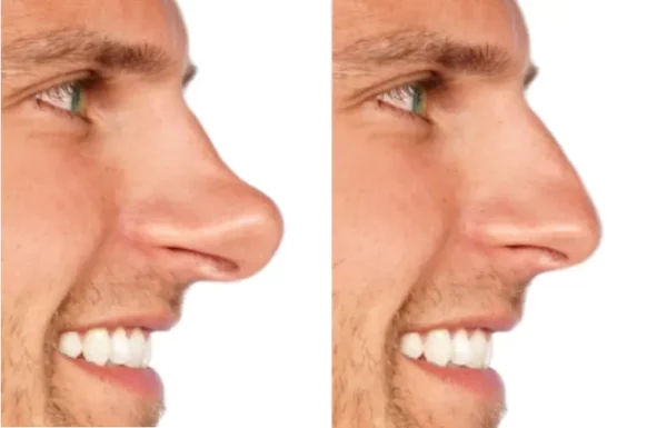 Simulation - Rhinoplastie - Nez – Image 12