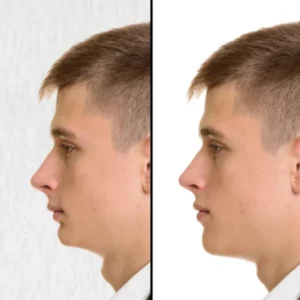 Homme avec une face courte photo avant après chirurgie