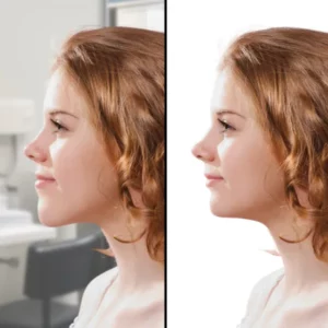 Photo avant après d'une femme opérée d'une face longue