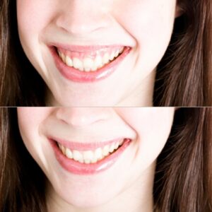 Sourire gingival opération maxillaire