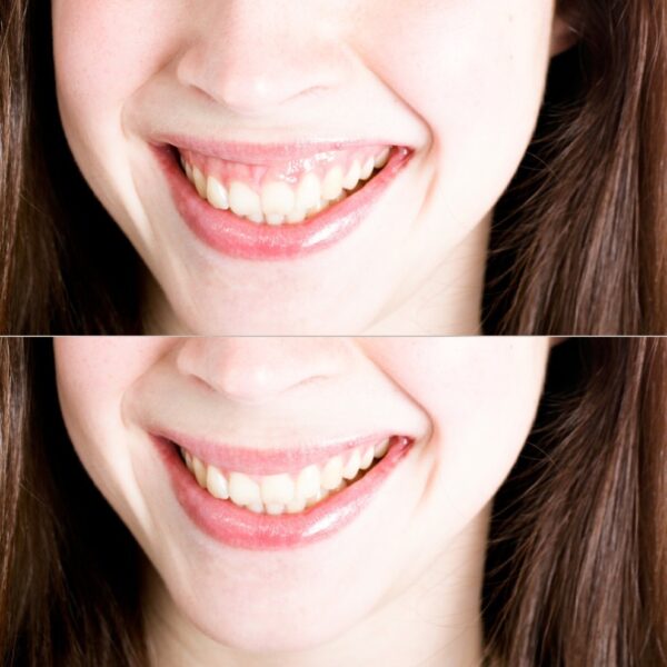 Sourire gingival opération maxillaire