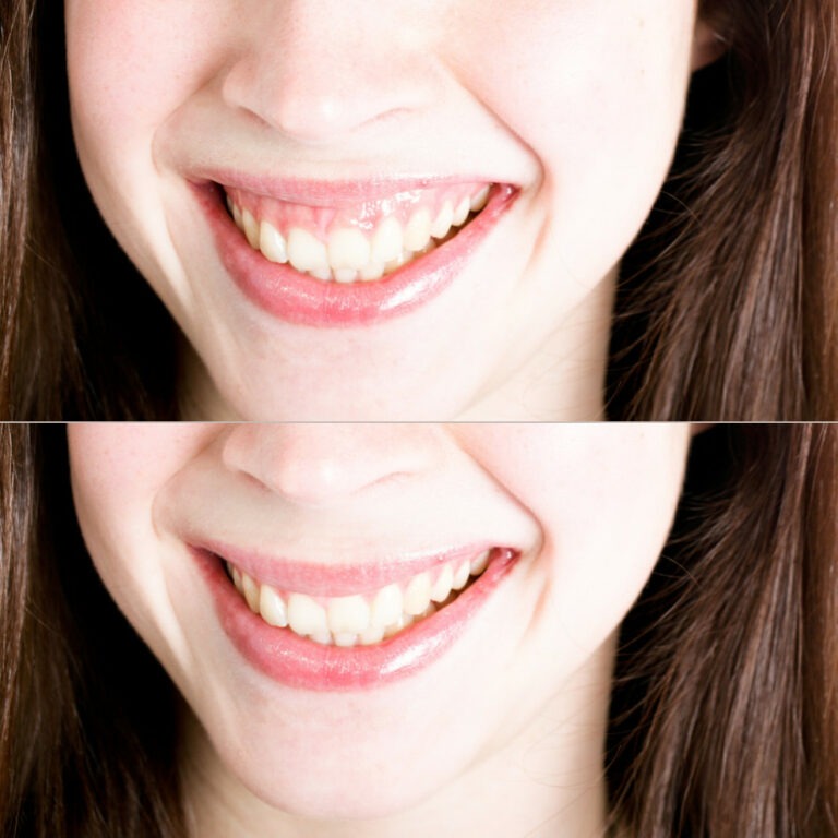 Sourire gingival (gencives visibles)