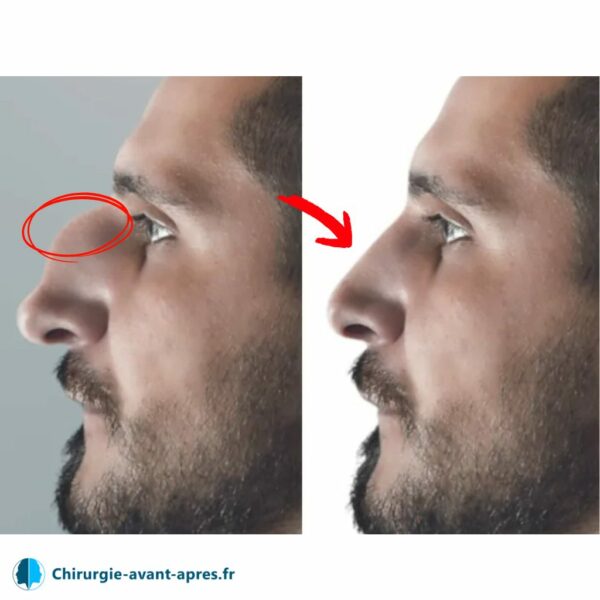 homme gros nez