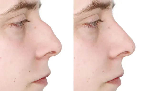 Simulation - Rhinoplastie - Nez – Image 10