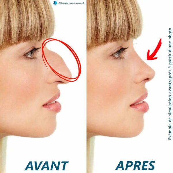 rhinoplastie