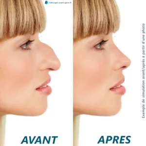 Photo d'une rhinoplastie avant/après