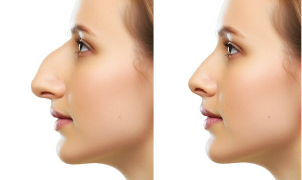 Simulation - Rhinoplastie - Nez – Image 7