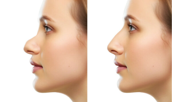 Simulation - Rhinoplastie - Nez – Image 6