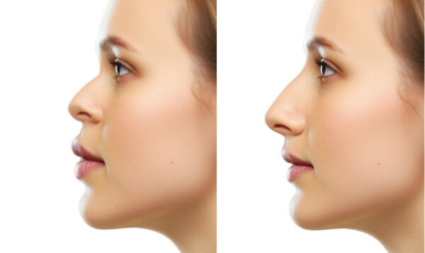 Simulation - Rhinoplastie - Nez – Image 5