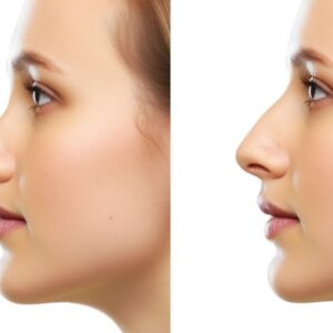 rhinoplastie nez en trompette avant après