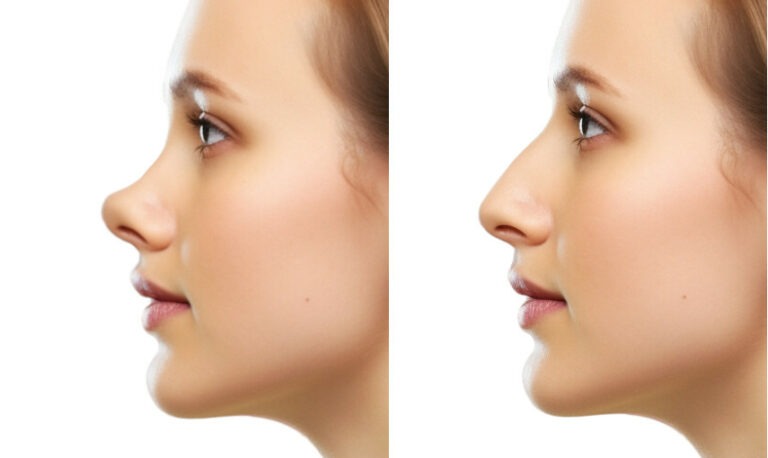 Rhinoplastie du nez retroussé