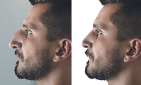 prix d'une rhinoplastie