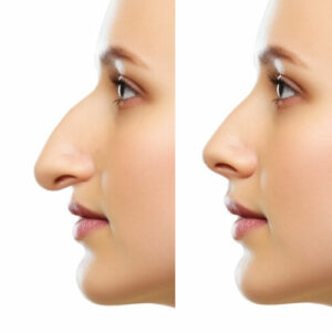 rhinoplastie pointe du nez avant apres