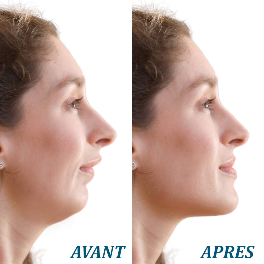 simulation d'avancement de la mâchoire chez une personna avec un menton fuyant
