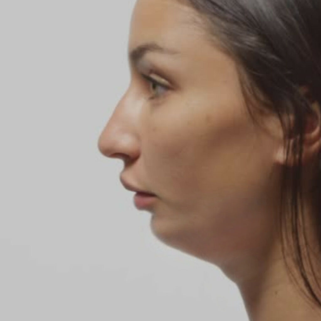 femme avec un menton fuyant c