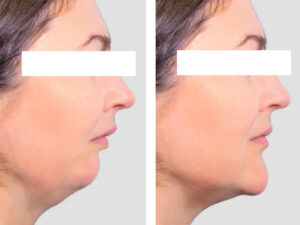 genioplastie chirurgie du menton menton en arriere menton en retrait et chirurgie bimaxillaire avancement