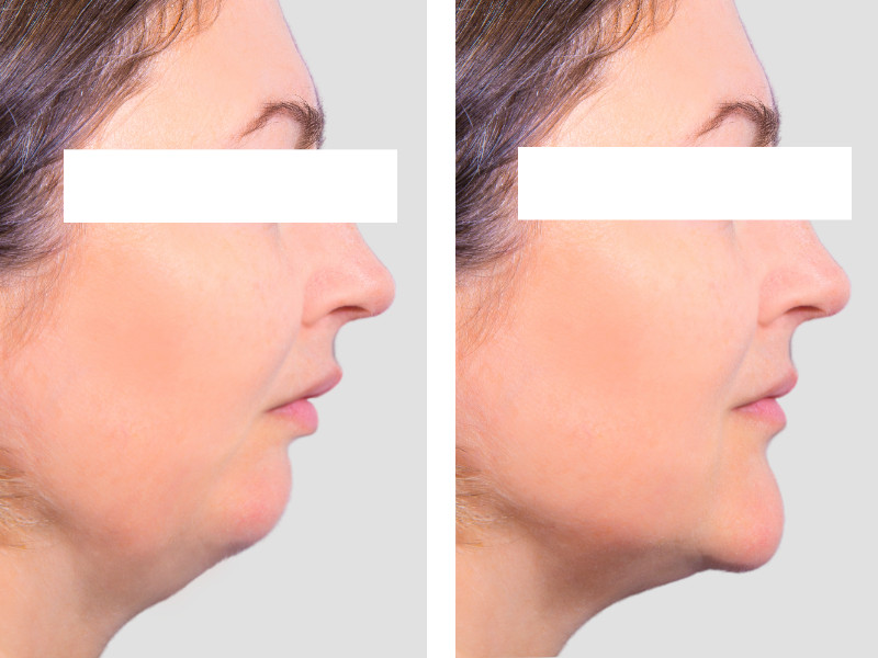 genioplastie chirurgie du menton menton en arriere menton en retrait et chirurgie bimaxillaire avancement