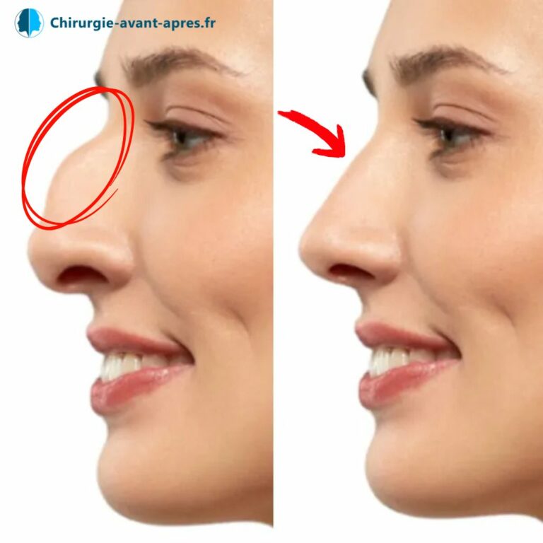 Rhinoplasty simulation