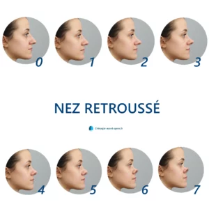 nez en trompette 1980