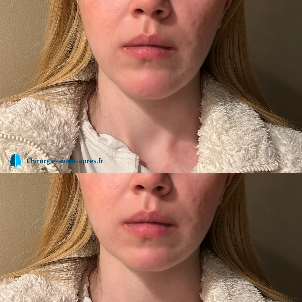 genioplastie reduction du menton vu de face