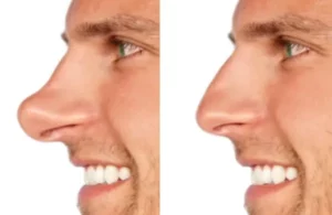 morphing rhinoplastie