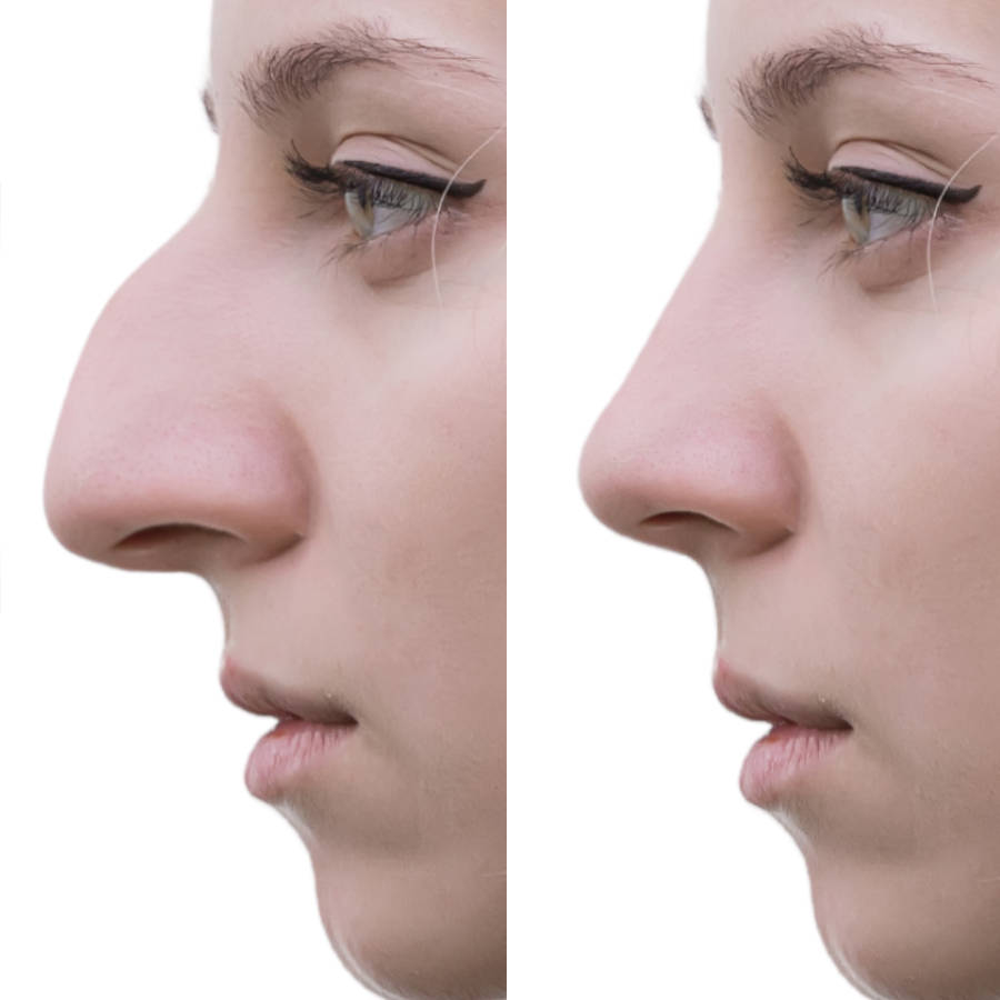 simulation 3d en chirurgie esthétique