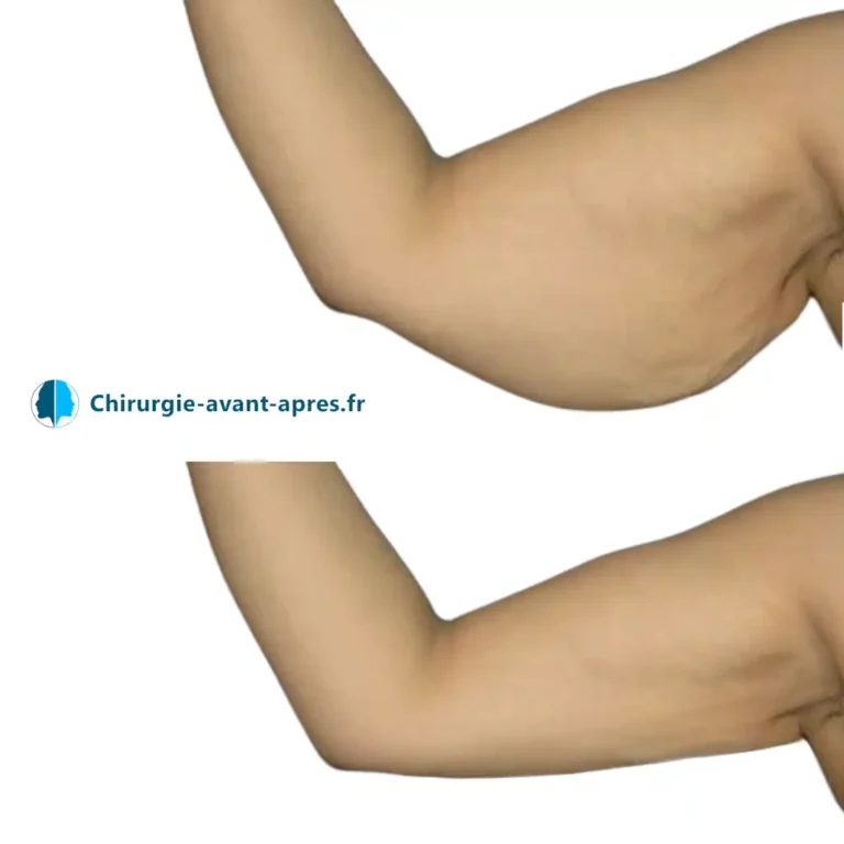 Simulation - Lifting des bras (brachioplastie)