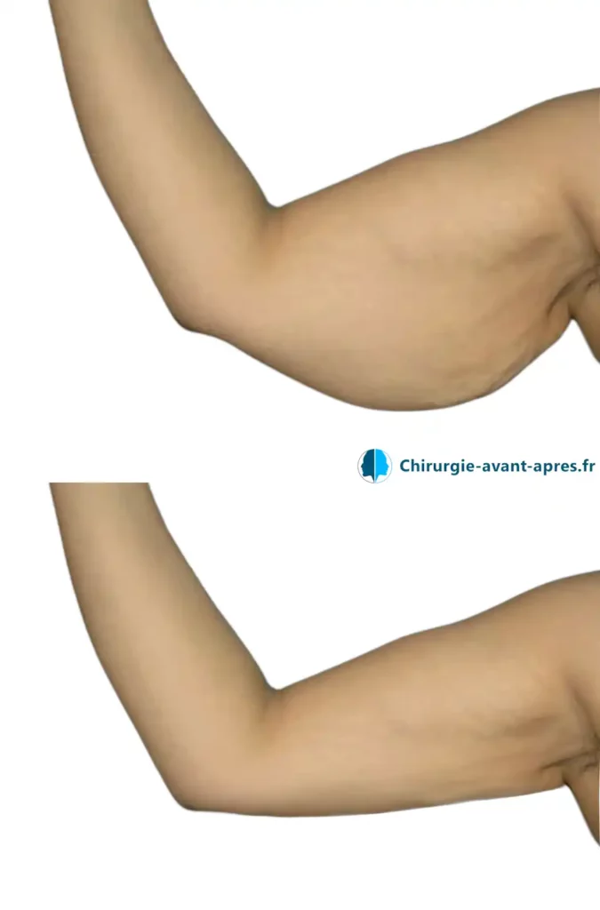 brachioplastie lifting bras peau qui pend