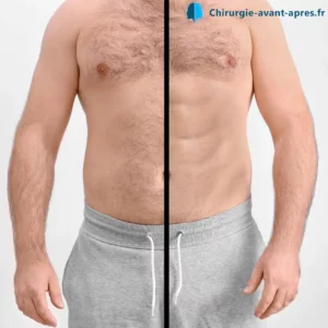 chirurgie abdos abdominal etching liposculpture