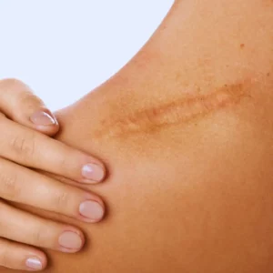 comment effacer cicatrice