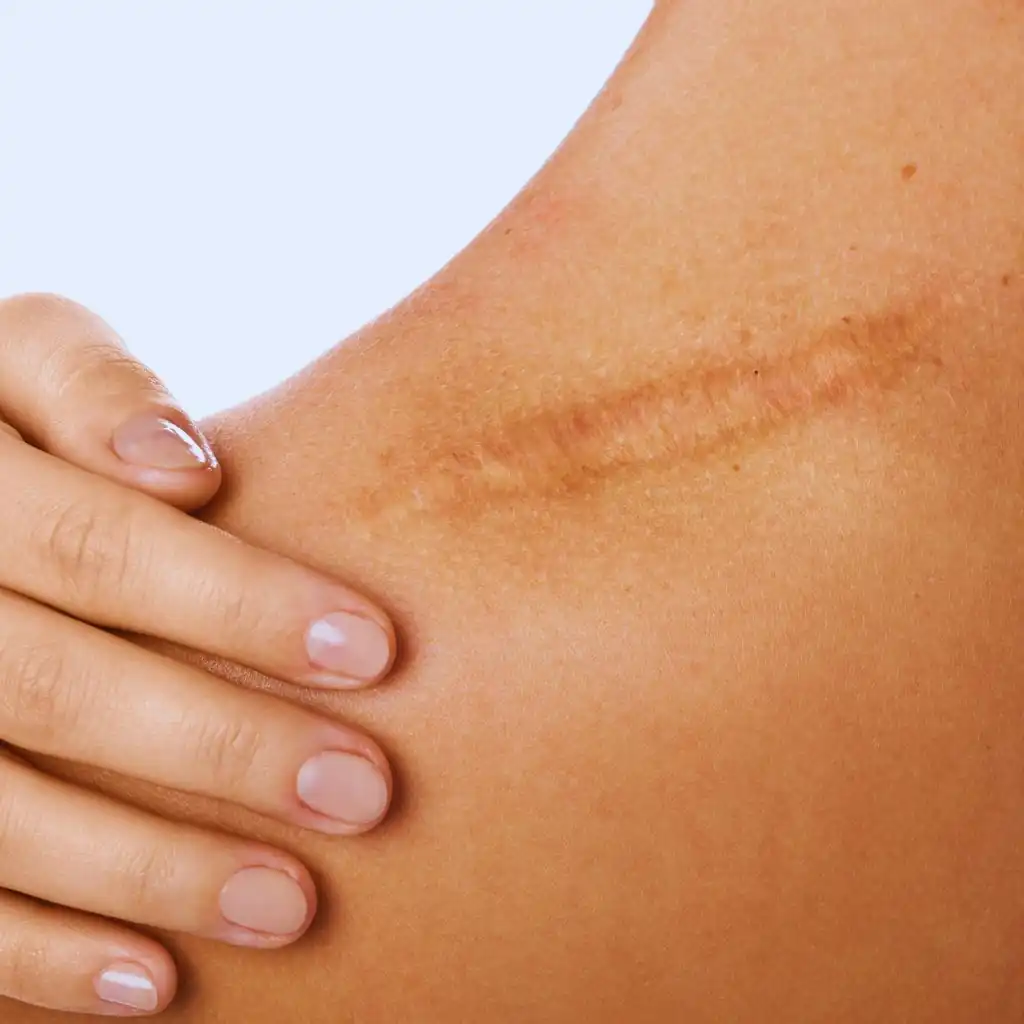 comment effacer cicatrice