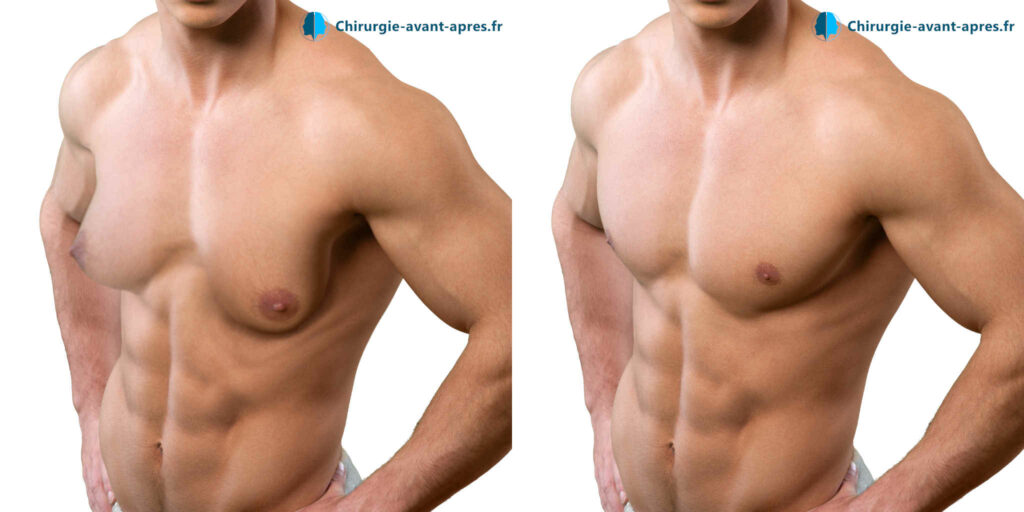 gynecomastie homme avec des seins
