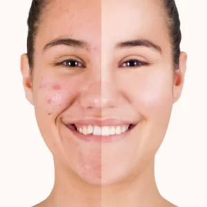 peeling