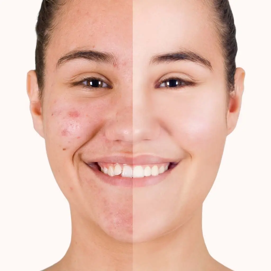 peeling
