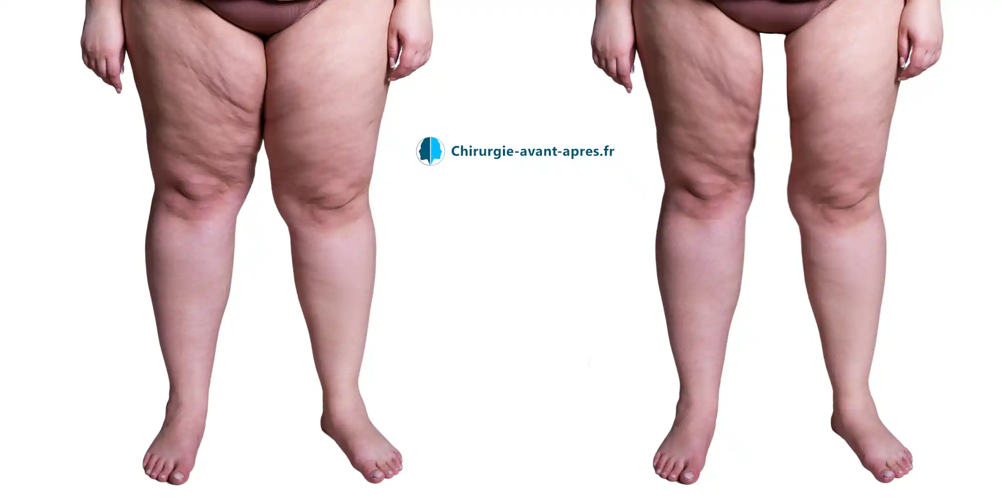 retendre la peau des cuisses lifting cruroplastie (2)