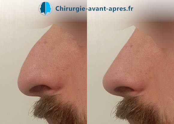 rhinoplastie avant après