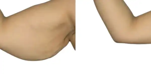 peau du bras qui pend