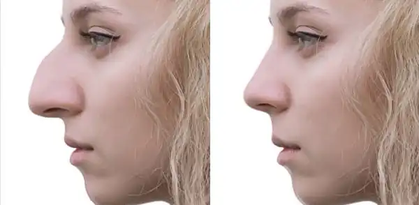 simulateur rhinoplastie
