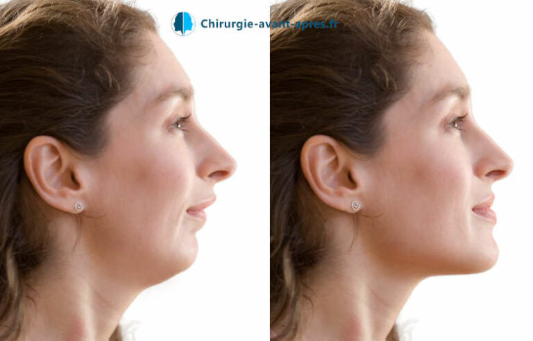 simulateur chirurgie menton fuyant