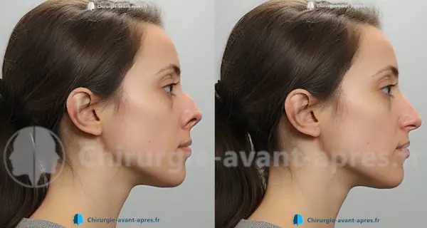 chirurgien du nez Annecy