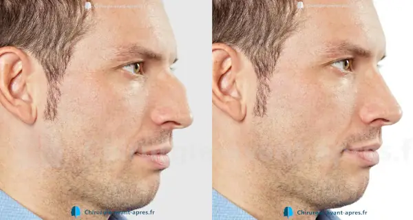 chirurgien du nez Le Havre