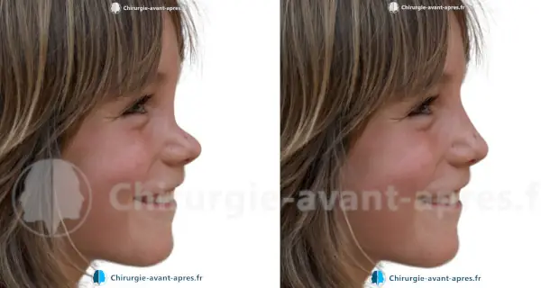 chirurgien du nez Rennes