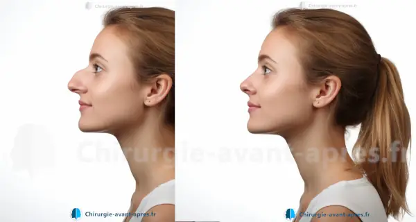 chirurgien du nez meches