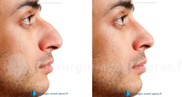 chirurgien nez nice