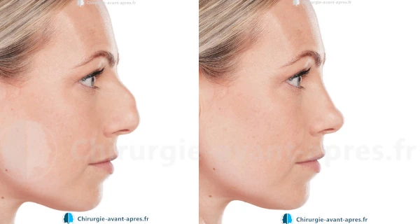 chirurgien nez paris