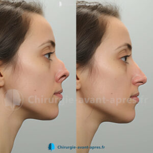 rhinoplastie Annecy avant apres