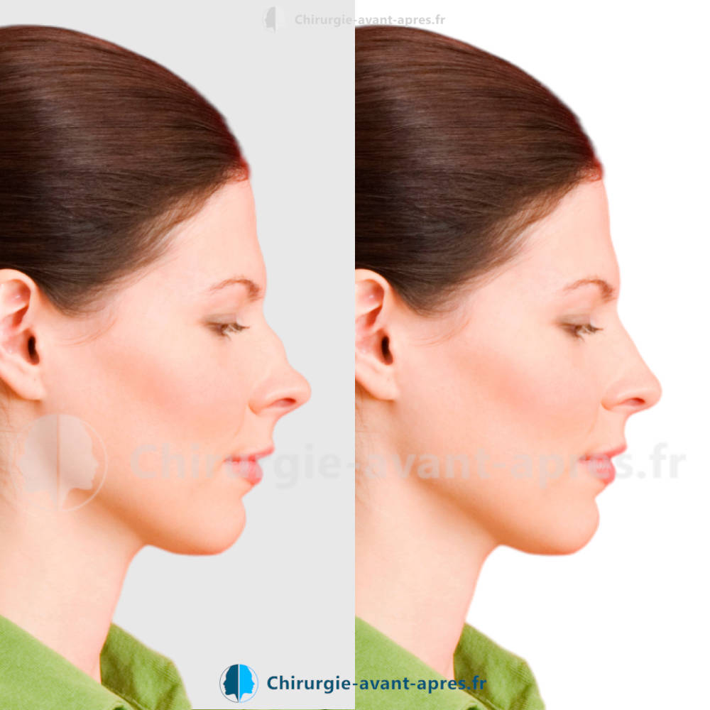 rhinoplastie Bordeaux avant apres