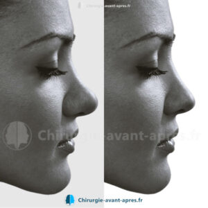 rhinoplastie Lille avant apres